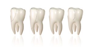 cracked teeth in Libertyville