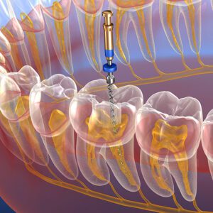 root canal in Waukegan